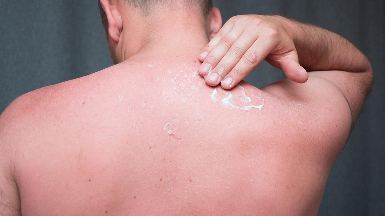 Bei leichten Sonnenbränden können After-Sun-Produkte Abhilfe schaffen. Bei leichten Sonnenbränden können After-Sun-Produkte Abhilfe schaffen.